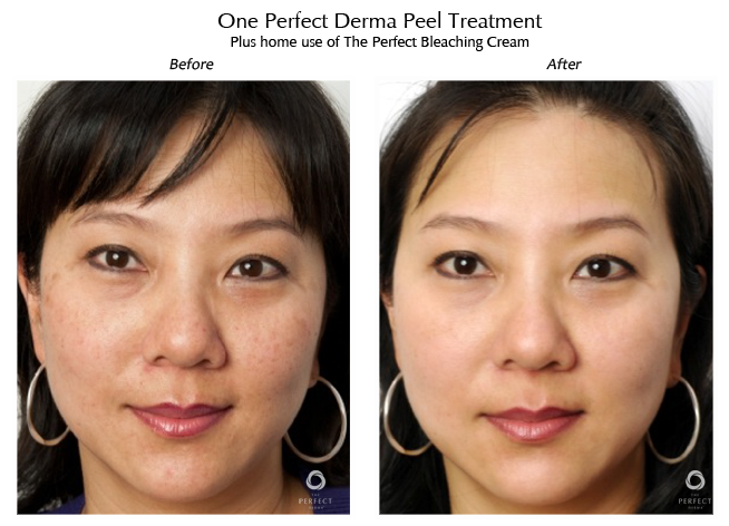 Peel Treatment Image