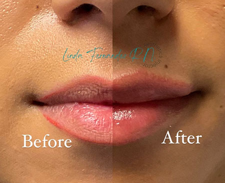 Fillers