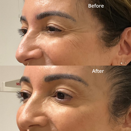 Wrinkle relaxers image