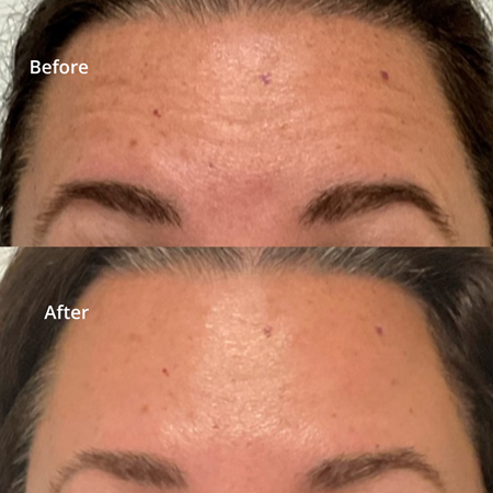 wrinkle relaxers before and after image